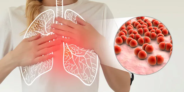 Ilustrasi Pneumonia (foto/net)