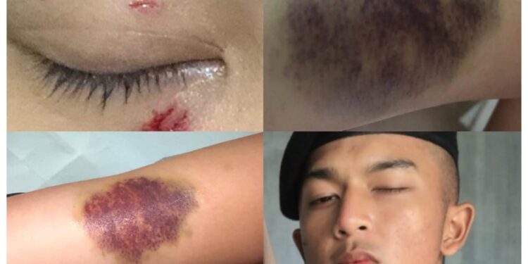 Sejumlah luka yang dialami Prischa Laura diduga dianiaya oknum Polda Jabar (foto/Instagram)