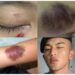 Sejumlah luka yang dialami Prischa Laura diduga dianiaya oknum Polda Jabar (foto/Instagram)