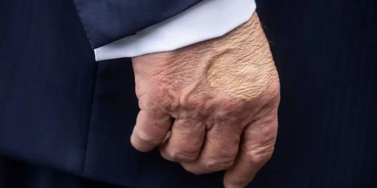 Donald Trump didiagnosis menderita insufisiensi vena kronis setelah mengalami pembengkakan. (Foto/Doc)
